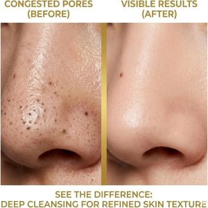 دستگاه میکرودرم ۴کاره مکنده جوش سرسیاه و پاکسازی پوست (Blackhead Remover)